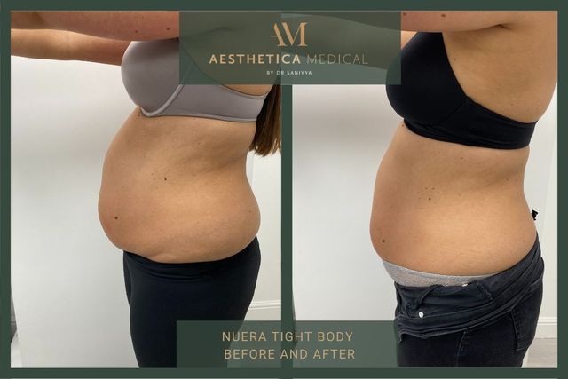 NuEra Tight skin tightening before and after pictures